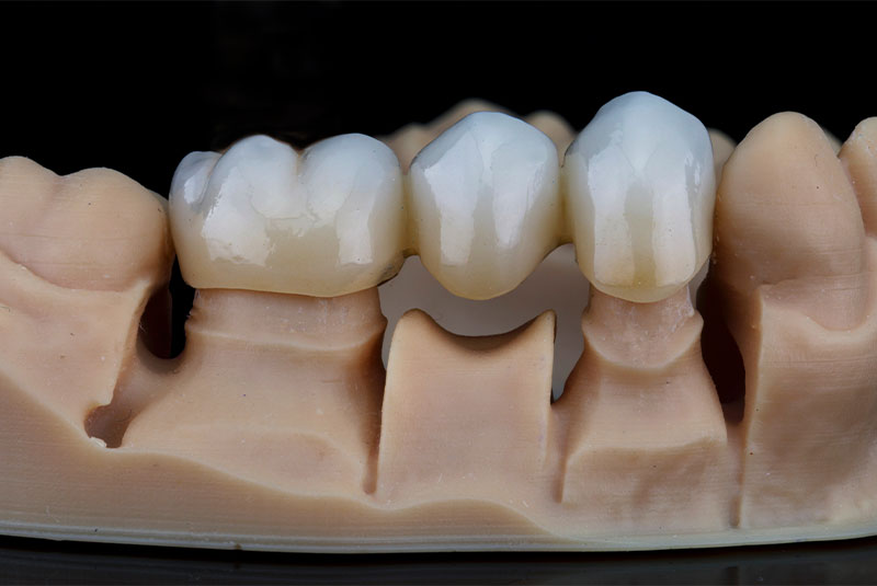dental bridge