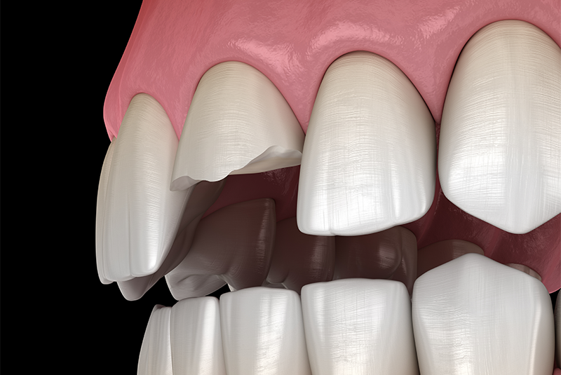 broken tooth