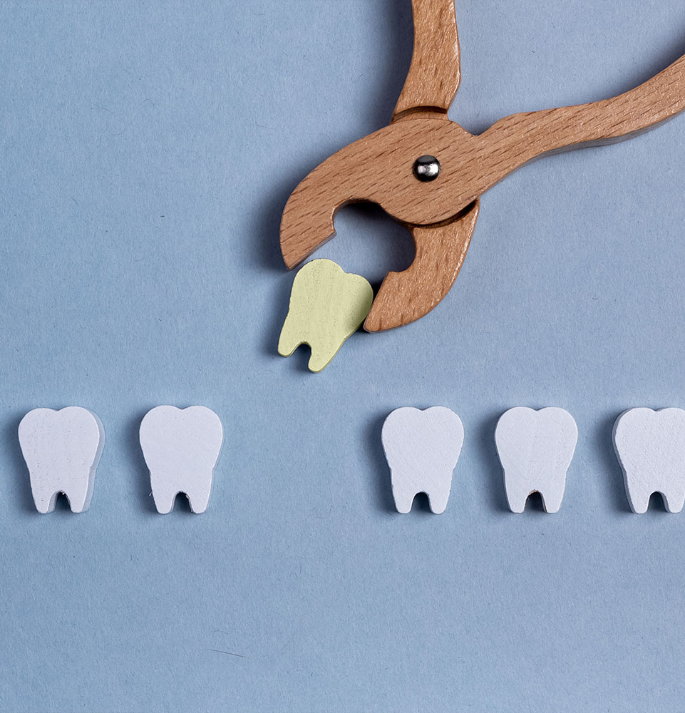 tooth removal