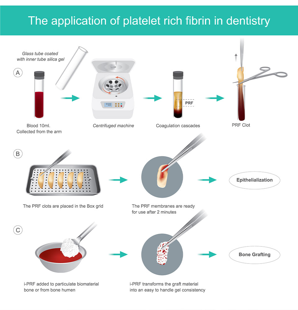 thumbnail image 2 of DDP PRF & GRF System Dental Implant Kit - Platelet Rich Fibrin, Stainless Steel, DN-316 2 of 6